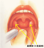 白い 扁桃 腺