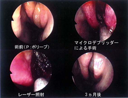 鼻茸